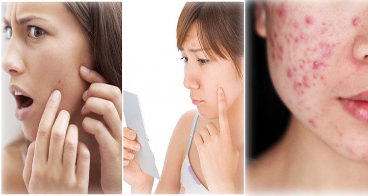 trị mụn thâm hiệu quả tại myphamlan